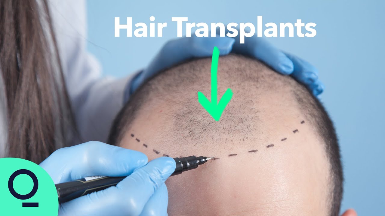 Read more about the article Why Istanbul Is The Place to Get Your Hair Back